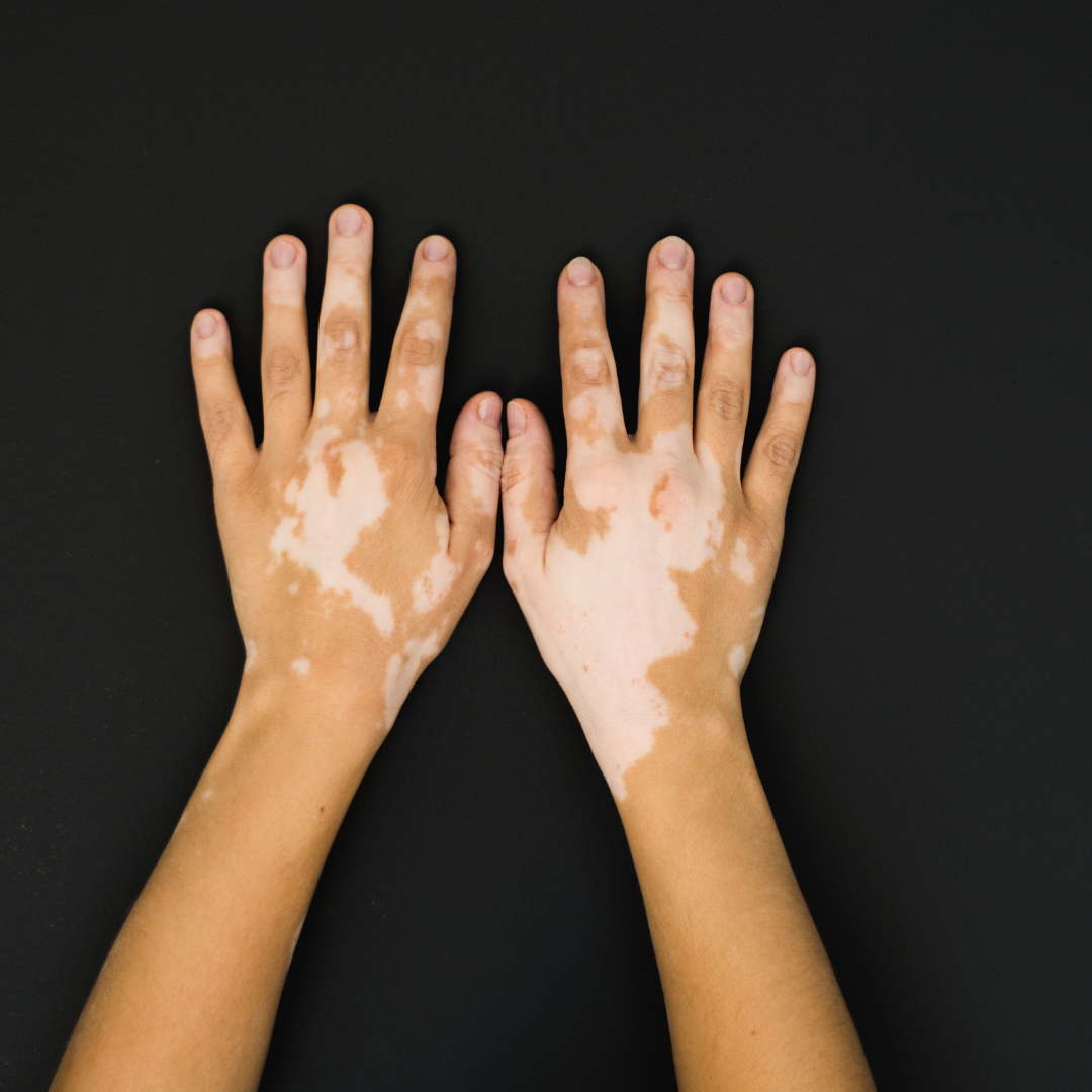 Vitiligo dermatologista Manaus