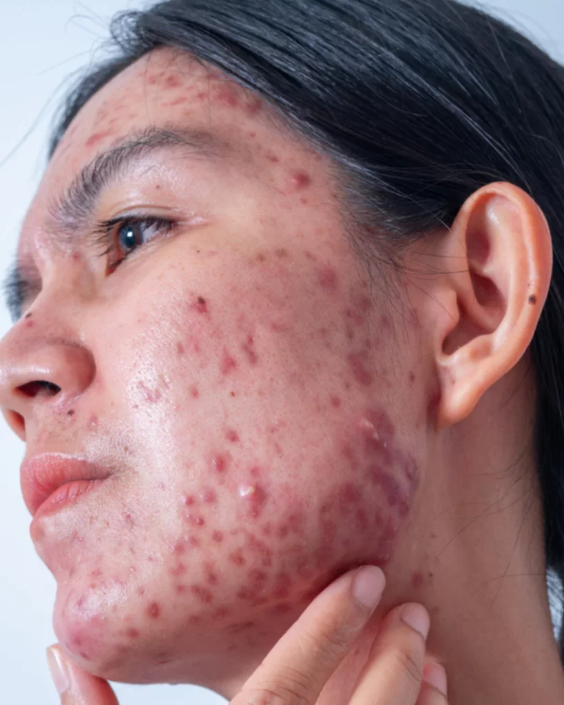 Acne espinhas dermatologista Manaus