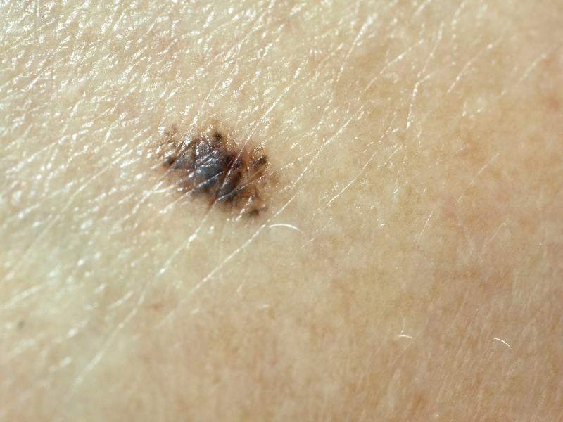 Câncer de pele dermatologista Manaus