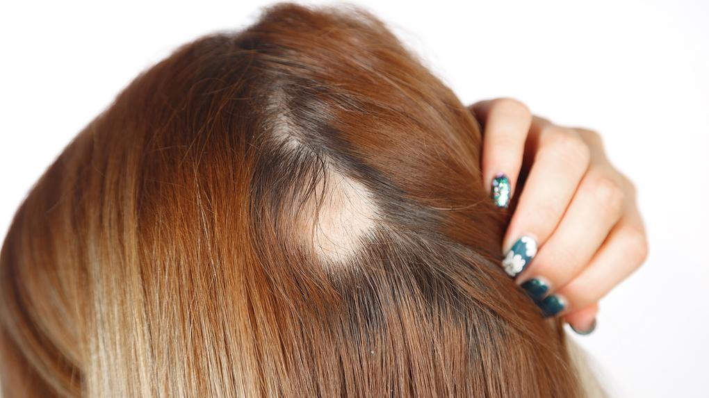 alopecia dermatologista manaus