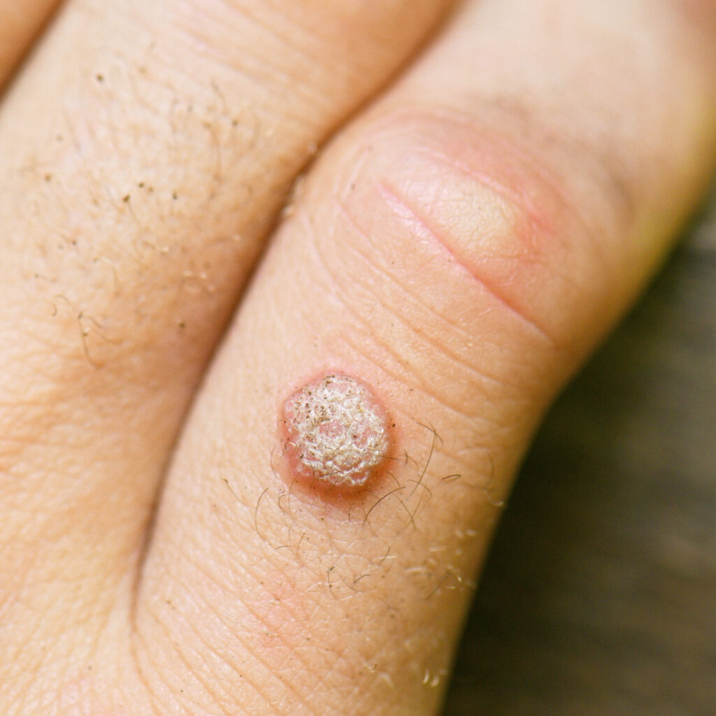 verrugas dermatologista manaus