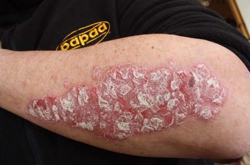 Psoríase dermatologista Manaus