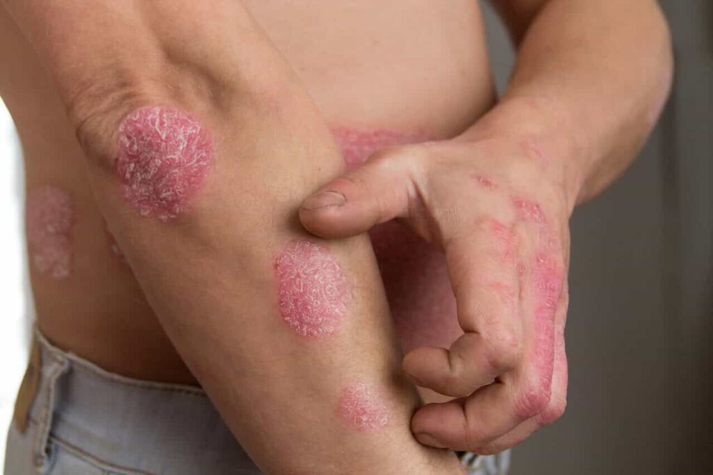 psoríase imunobiológico dermatologista manaus